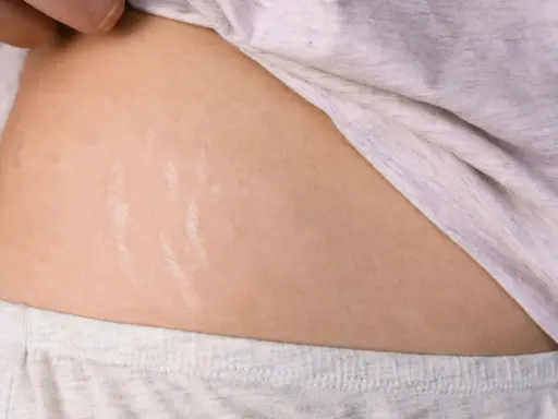 Pelle con smagliature sul fianco, segno di cambiamenti corporei.