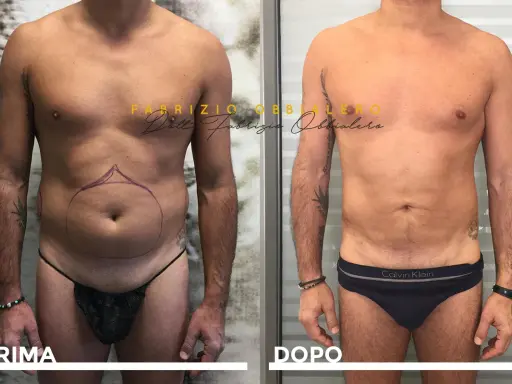Prima e dopo liposuzione pube uomo. Addome più definito e tonico, con contorni migliorati.