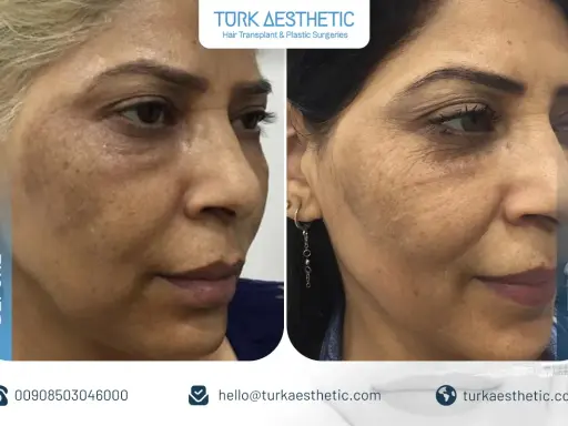 Risultati visibili del trattamento laser CO2 viso: prima e dopo, con pelle più liscia e uniforme.