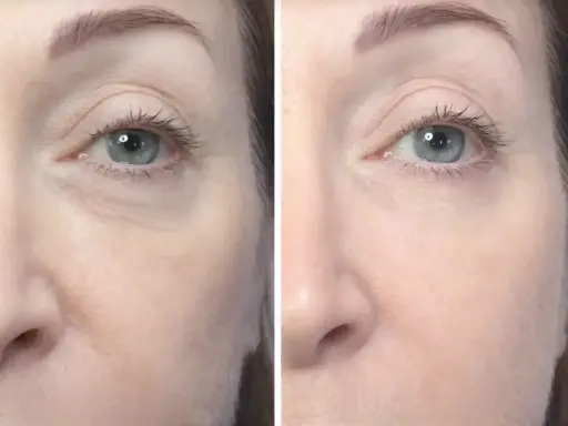 Prima e dopo biorivitalizzazione occhiaie: pelle più liscia e luminosa sotto gli occhi.