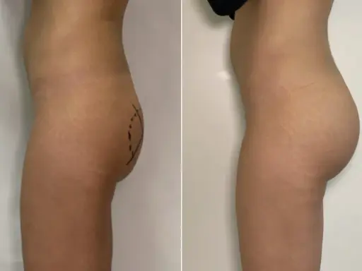Prima e dopo gluteoplastica mini invasiva: un aumento del volume e della proiezione dei glutei, con un risultato naturale.