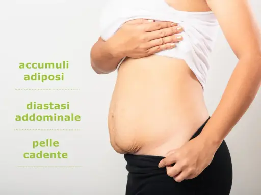Addominoplastica cos'è: immagine mostra addome con accumuli adiposi, diastasi addominale e pelle cadente, condizioni trattabili.