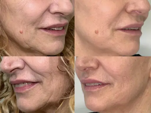 Punture di vitamine viso prima e dopo: la pelle appare più liscia e luminosa, con una riduzione delle rughe e un aspetto più giovane.
