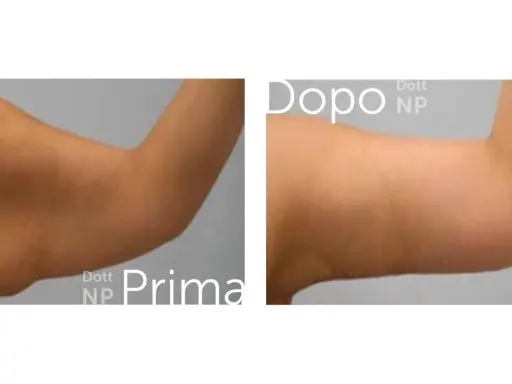Prima e dopo liposuzione braccia: un braccio più tonico e definito.
