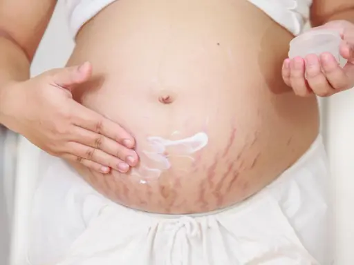 Pancia con smagliature rosse, una mano applica crema idratante per capire perchè vengono le smagliature.