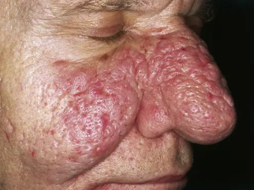Primo piano del naso e guancia di un uomo con rinofima. La pelle è arrossata, ispessita e presenta noduli. Potrebbe essere utile una crema per rinofima.