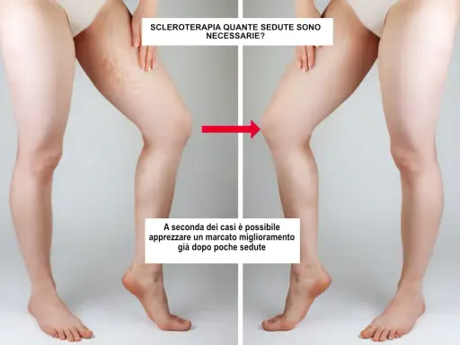 Gambe prima e dopo sclerosanti: la terapia riduce visibilmente le teleangectasie, mostrando un netto miglioramento.