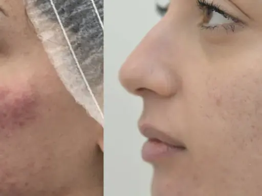 Prima e dopo: pelle con acne e rossori, poi migliorata. Nessun effetto collaterale visibile di Dermamelan.
