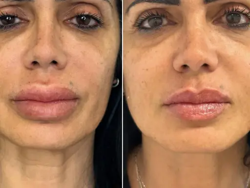 Volto prima e dopo ialuronidasi: labbra più definite e pelle più liscia.