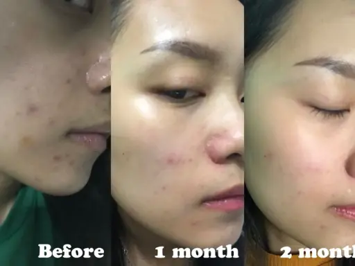 Acne migliorata con acido salicilico: prima, dopo 1 mese e dopo 2 mesi.