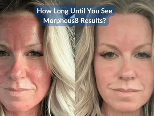 Prima e dopo Morpheus8: il volto arrossato e irritato solleva dubbi sui risultati.