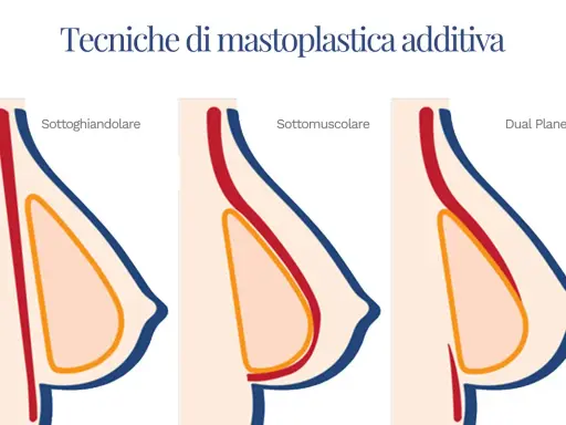 Illustrazione delle tecniche di mastoplastica additiva: sottoghiandolare, sottomuscolare e Dual Plane. Le opinioni sulla tecnica Dual Plane variano.