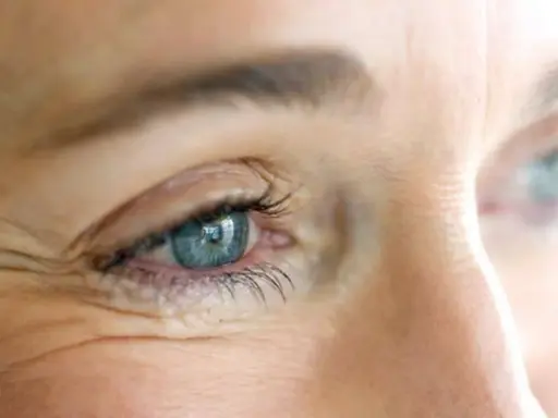 Occhio con evidenti zampe di gallina, un segno del tempo che il botox può attenuare per un aspetto più giovane.