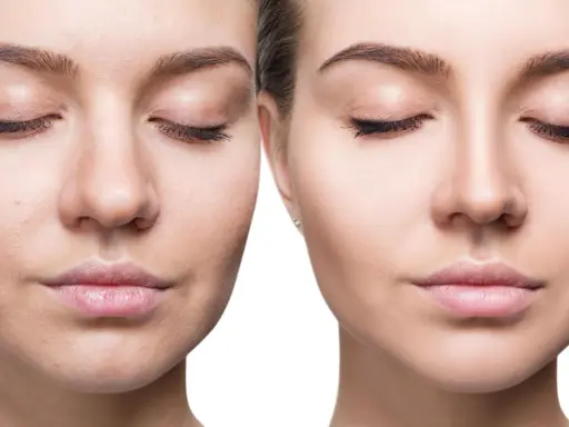 Viso prima e dopo: pelle imperfetta e spenta a sinistra, pelle luminosa e levigata a destra.