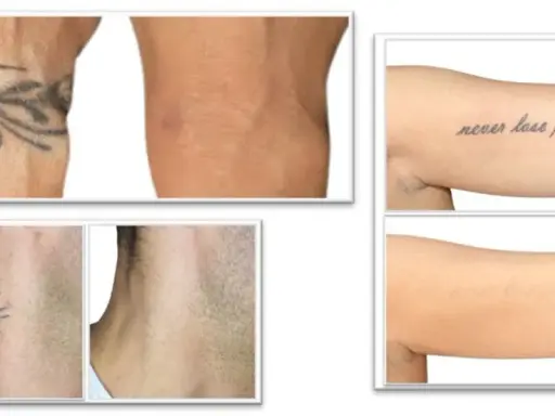 Prima e dopo la rimozione tatuaggi: braccio con tatuaggio tribale e braccio senza, collo con tatuaggio floreale e collo senza, braccio con scritta "never lose faith" e braccio senza.