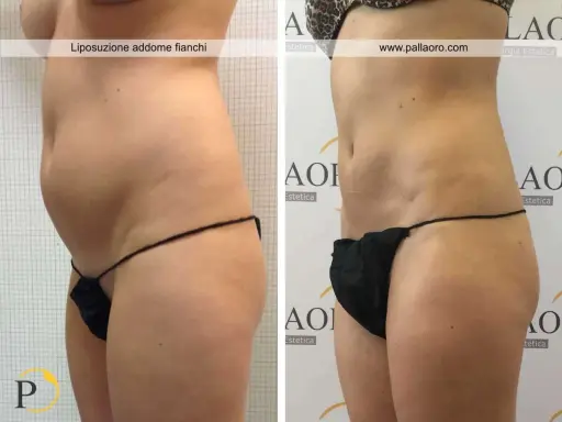 Addome e fianchi prima e dopo liposuzione. La silhouette è visibilmente più snella e definita.
