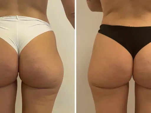 Lipofilling glutei prima e dopo: confronto visivo dei risultati. I glutei appaiono più voluminosi e armoniosi dopo il trattamento.
