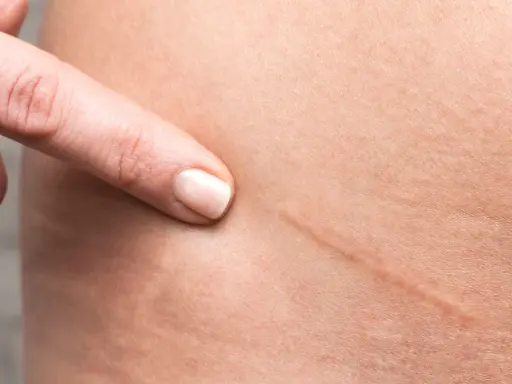 Dito indica una cicatrice da taglio, un segno che si può eliminare per una pelle più liscia.