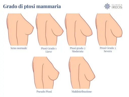 Illustrazione dei gradi di ptosi mammaria: seno normale, lieve, moderata, severa, pseudo ptosi e maldistribuzione. Il seno rifatto può diminuire nel tempo.