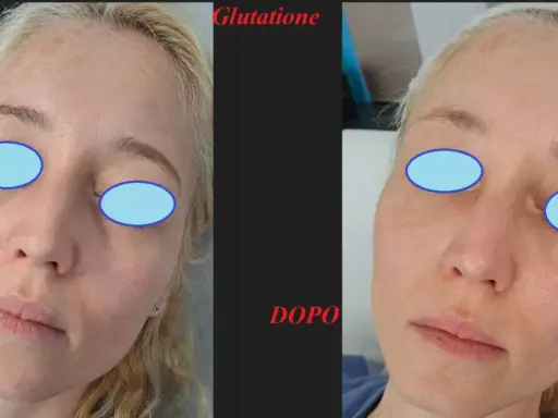 Prima e dopo un trattamento di glutatione per un miglioramento visibile del risultato peeling chimico.
