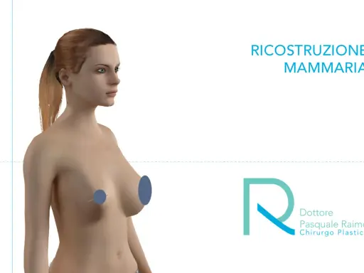Modello 3D di un torace femminile, con aree evidenziate per illustrare la mastectomia e la ricostruzione mammaria.