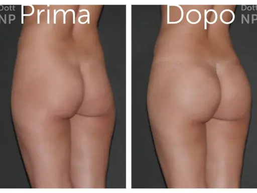 Prima e dopo gluteoplastica senza protesi: un risultato naturale e armonioso.