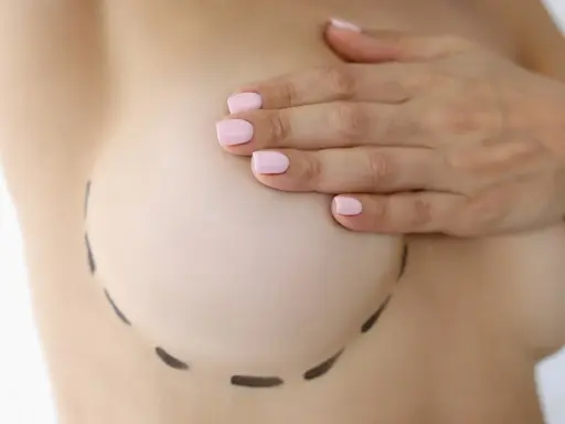 Contorno del seno segnato per intervento. Informazioni sui lipofilling seno rischi e benefici.
