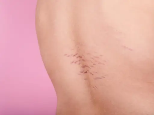 Pelle con smagliature viola, segni di crescita o cambiamenti corporei, su sfondo rosa.