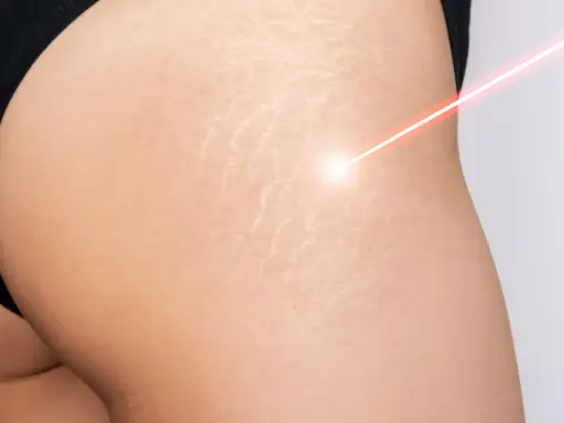 Laser treatment on skin with smagliature, showing a path to come eliminare le smagliature.