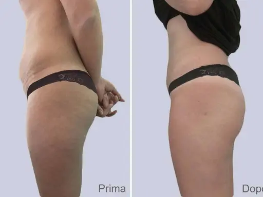 Confronto prima e dopo: la liposuzione come funziona per rimodellare il corpo, riducendo accumuli adiposi e migliorando la silhouette.