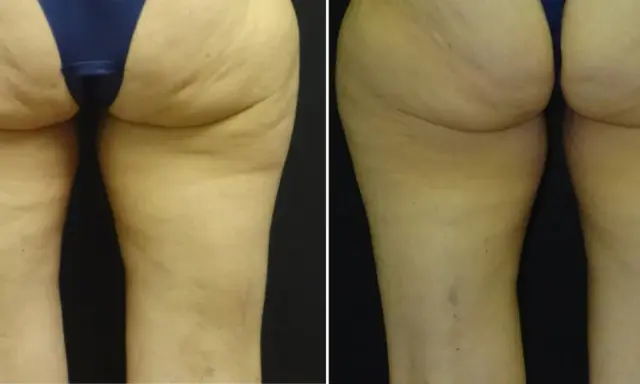 Gambe prima e dopo VelaShape: la pelle appare più liscia e tonica, con una riduzione visibile della cellulite.