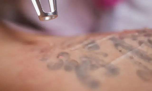 Laser che rimuove un tatuaggio, mostrando la pelle in fase di guarigione.