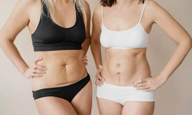 Due donne mostrano i loro addomi, uno con smagliature e l'altro con una cicatrice, un confronto prima e dopo un mommy makeover.