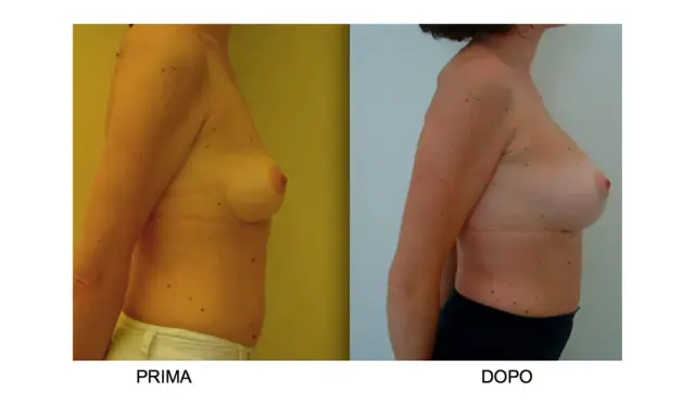 Confronto seno rifatto prima e dopo: immagine mostra il profilo di una donna, prima e dopo un intervento di mastoplastica additiva, evidenziando il cambiamento.