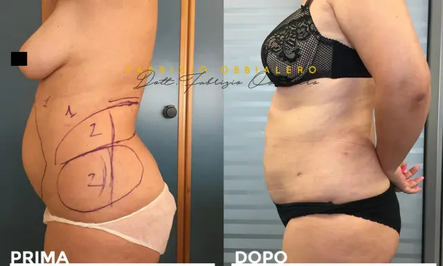 Addome prima e dopo liposcultura: il fianco sinistro mostra le marcature pre-operatorie, il fianco destro il risultato.