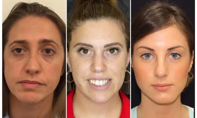 Confronto prima/dopo: zigomi rifatti male, con risultati innaturali e gonfi.