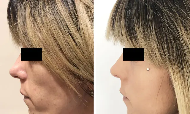 Prima e dopo lipofilling viso: il lato sinistro mostra un viso con contorni meno definiti, il destro un viso più armonioso. Esperienze negative da valutare.