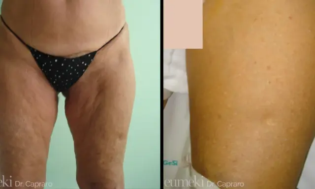 Lifting cosce: prima e dopo, con attenzione alle cicatrici e alla texture della pelle.