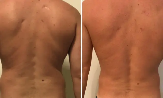 Risultati visibili di liposuzione schiena prima e dopo: la schiena appare più definita e liscia, con una riduzione del grasso accumulato.