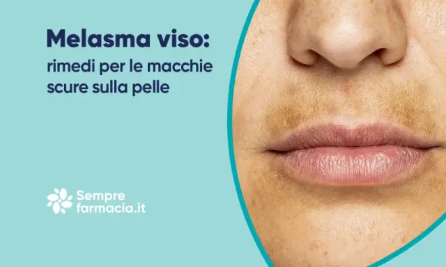 Primo piano del viso con melasma, evidenziando la zona baffetti scura e macchie sulla pelle. Rimedi per il melasma.