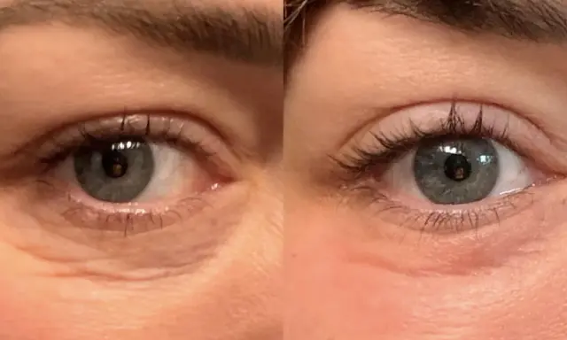 Occhi prima e dopo peeling TCA: rughe attenuate e pelle più liscia.