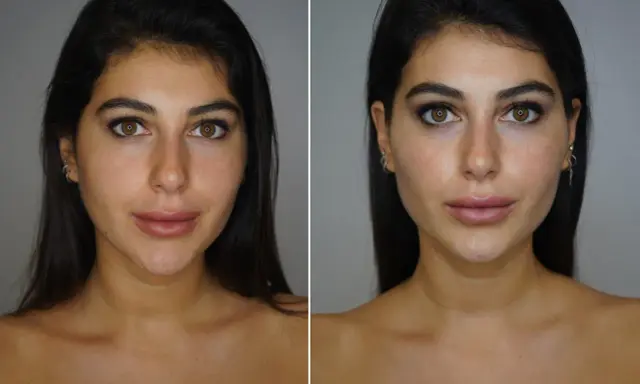 Prima e dopo: un volto femminile con labbra più piene e un contorno mascella definito, suggerendo un trattamento di filler mascella donna.