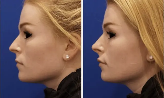 Profilo di donna prima e dopo rinofiller naso frontale. Il trattamento ha migliorato la linea del naso e del mento.
