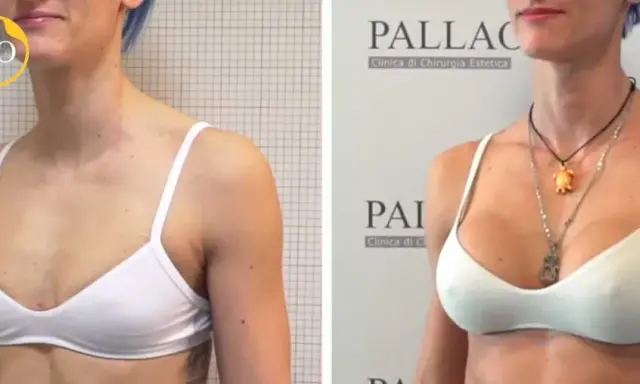 Prima e dopo: seno rifatto taglia 2, un risultato naturale e armonioso.