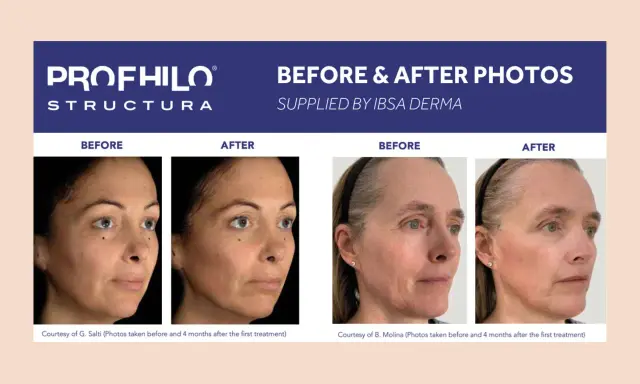 Profhilo Body: risultati prima e dopo. Due donne mostrano miglioramenti visibili della pelle dopo il trattamento.