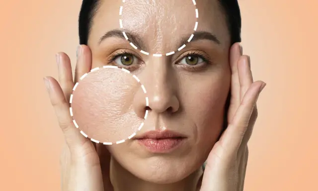 Primo piano di una donna con cerchi tratteggiati che evidenziano rughe e pori dilatati, suggerendo un trattamento di peeling.