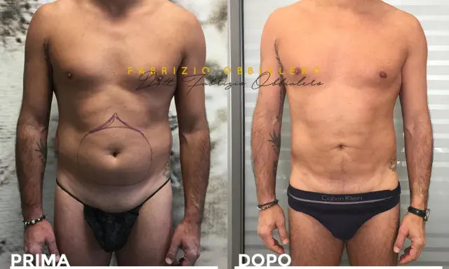 Prima e dopo liposuzione pube uomo. Addome più definito e tonico, con contorni migliorati.