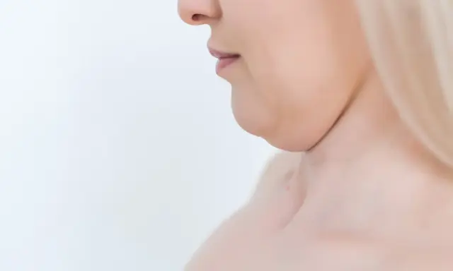 Primo piano del profilo di una donna con doppio mento, un'area che molte persone desiderano migliorare per capire come dimagrire sotto il mento.