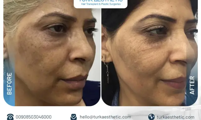 Risultati visibili del trattamento laser CO2 viso: prima e dopo, con pelle più liscia e uniforme.