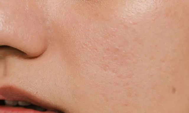Pelle arrossata e screpolata, con piccole imperfezioni, tipica di un'ustione o un peeling chimico.